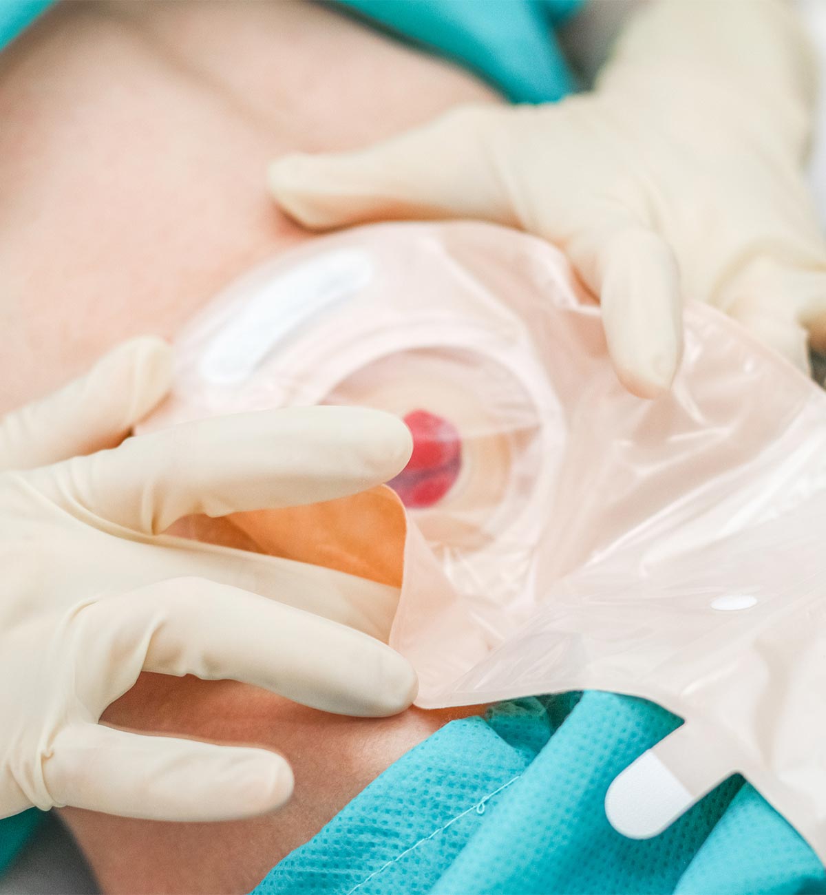 Bianca Verpoest Gastrostomie